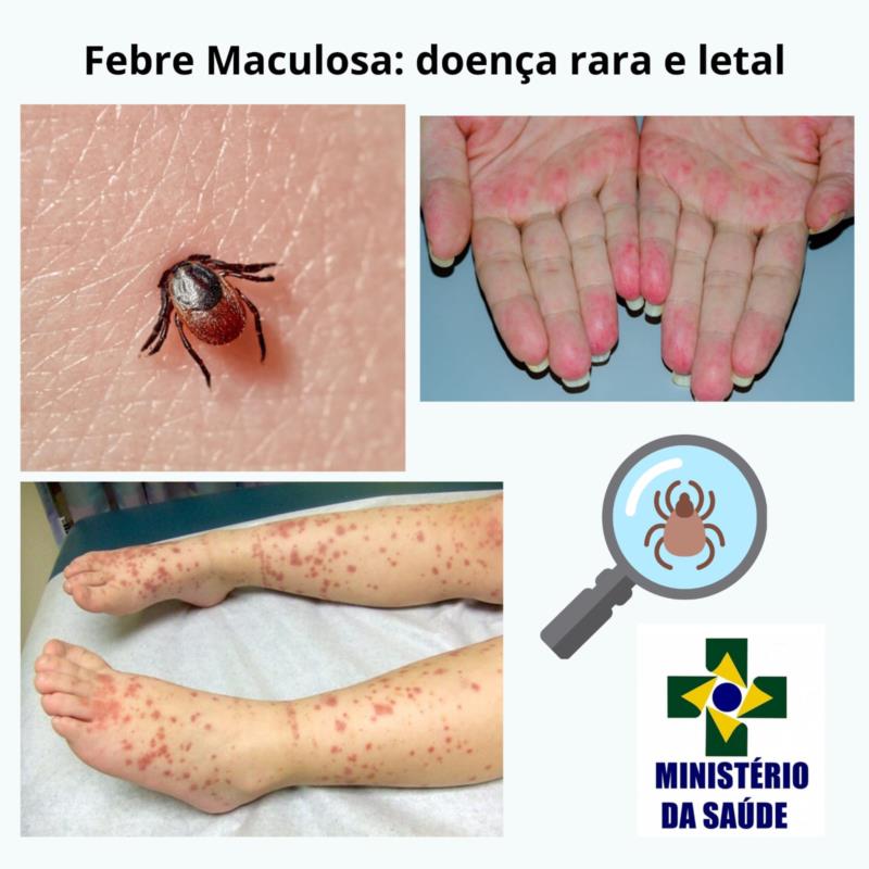 Febre Maculosa, saiba como evitar a infecção